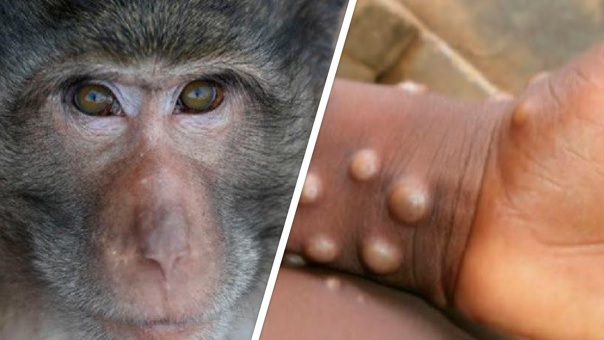 Поки тривають епідеміологічні дослідження причин появи хвороби у нетипових місцях, Суспільне пояснює що наразі відомо про мавпячу віспу.