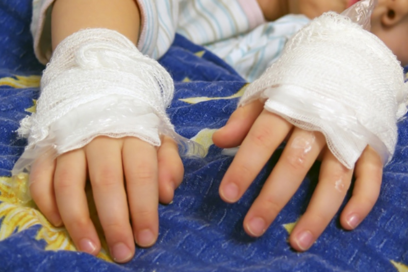 На Виноградівщині 6-річна дівчинка отримала серйозні опіки: відомі деталі інциденту