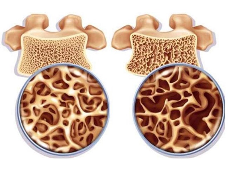 Особенности лечение остеопороза