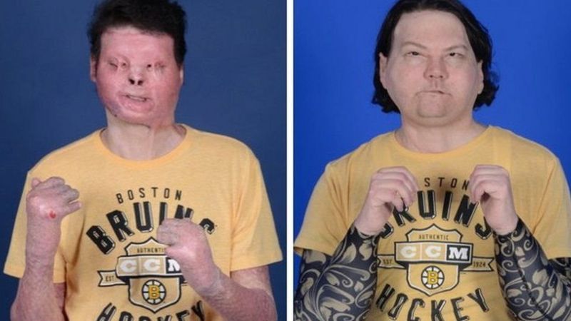 Врачи в Нью-йорке провели первую в истории успешную пересадку лица и двойную пересадку руки.