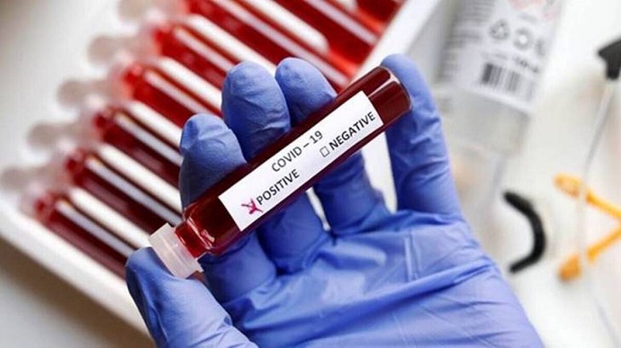За минулу добу  в Ужгороді виявлено 3 нові випадки коронавірусної інфекції.
