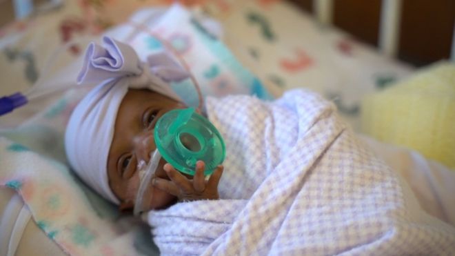 З лікарні у США виписали дитину, яка народилася з вагою лише 245 г і вважається найменшою з тих, що вижили після передчасних пологів.

